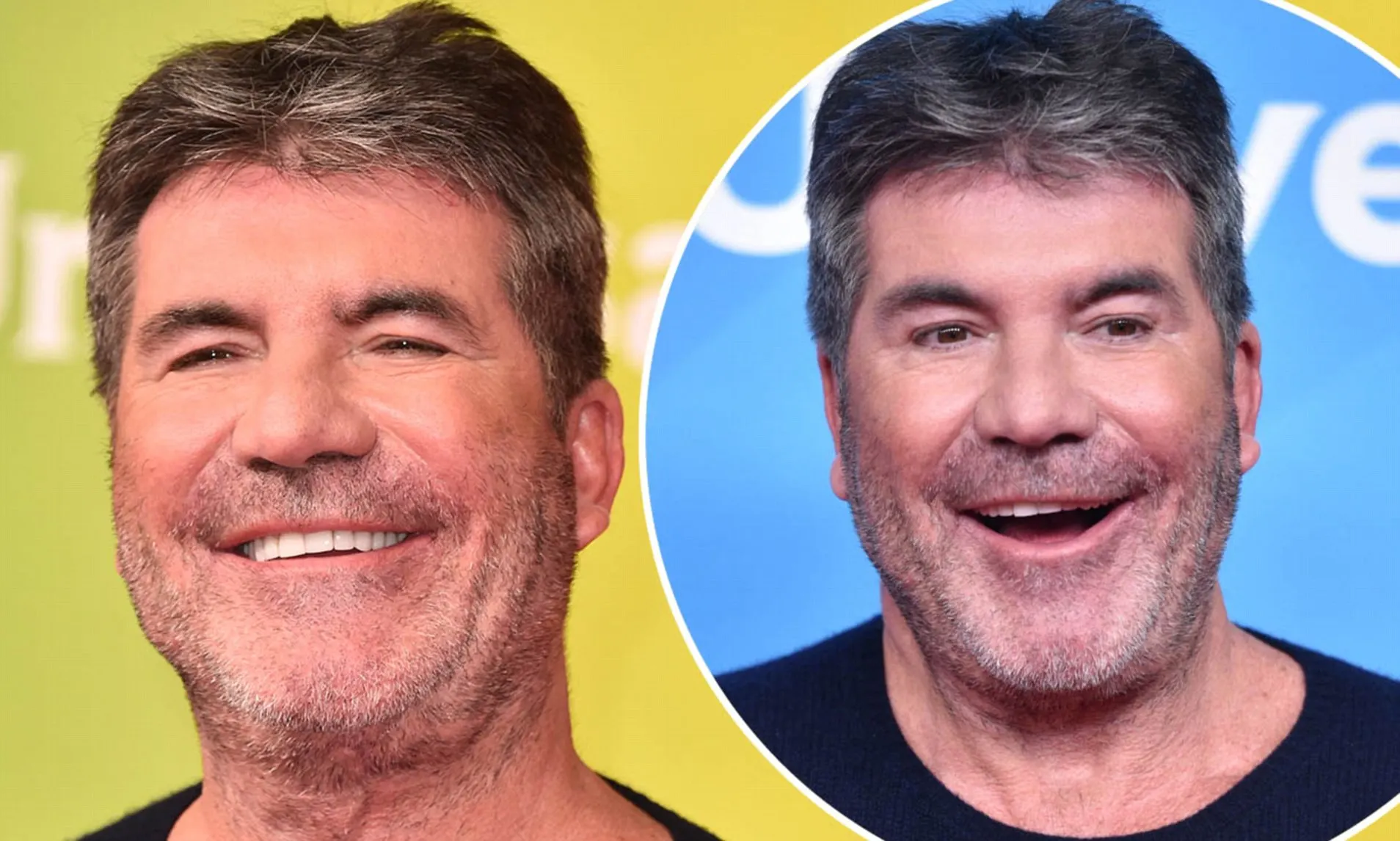 Simon Cowell PLsatic Surgery Before and After