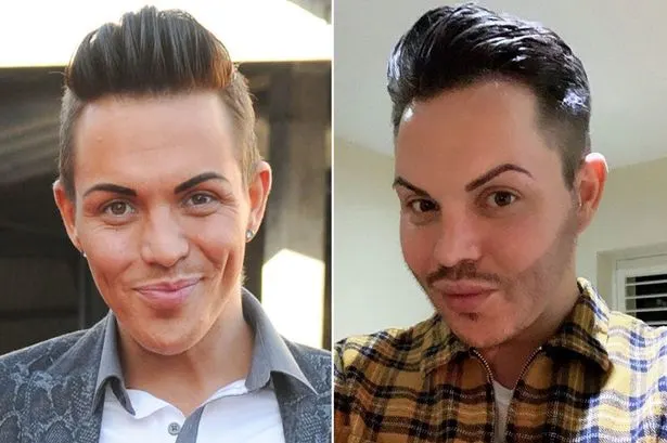 Bobby Norris Plastic Surgery Before and After