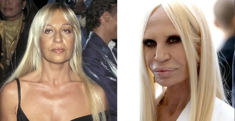 Donatella Versace Plastic Surgery Gone Wrong February 2024