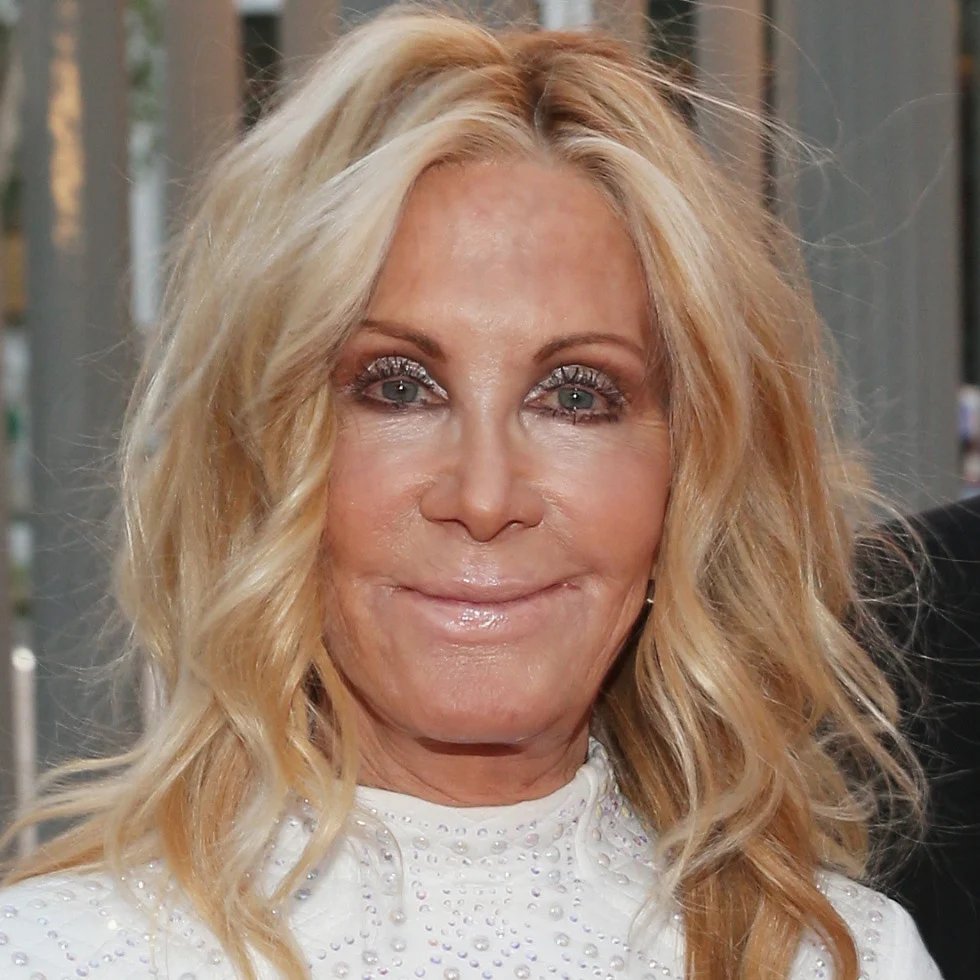 Joan Van Ark Plastic Surgery Before and After 