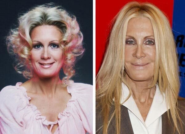 Joan Van Ark Plastic Surgery Before and After