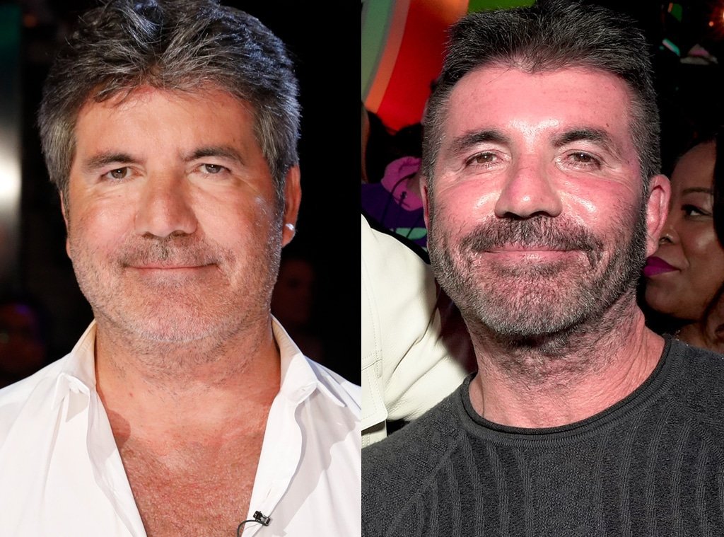 Simon Cowell PLsatic Surgery Before and After